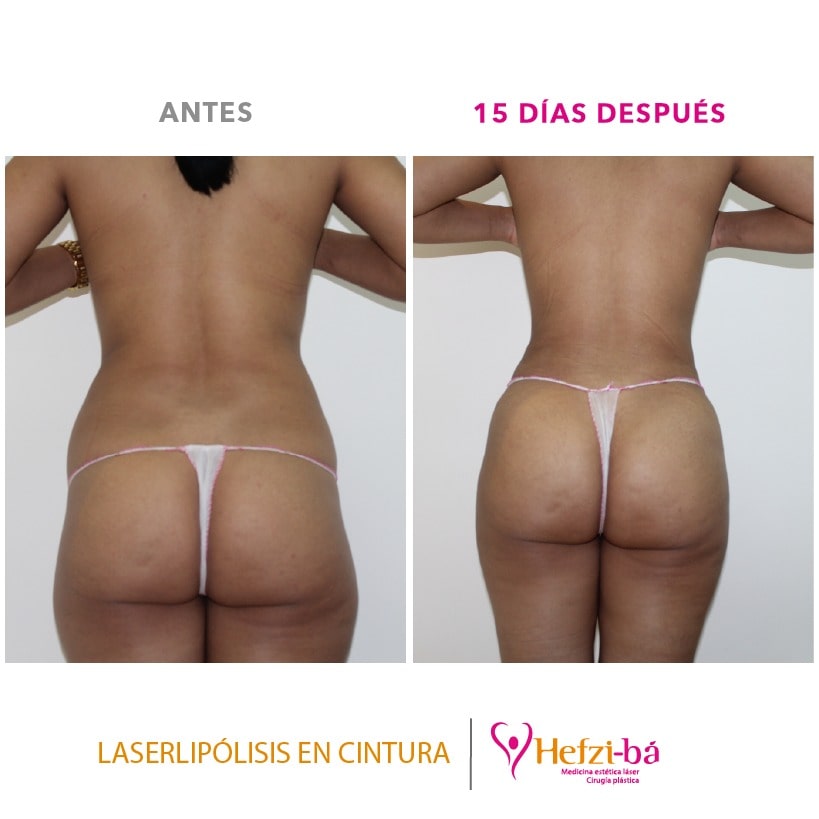 Antes y Despues Laserlipolisis 1