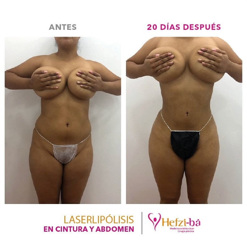 Antes y Despues Laserlipolisis 10