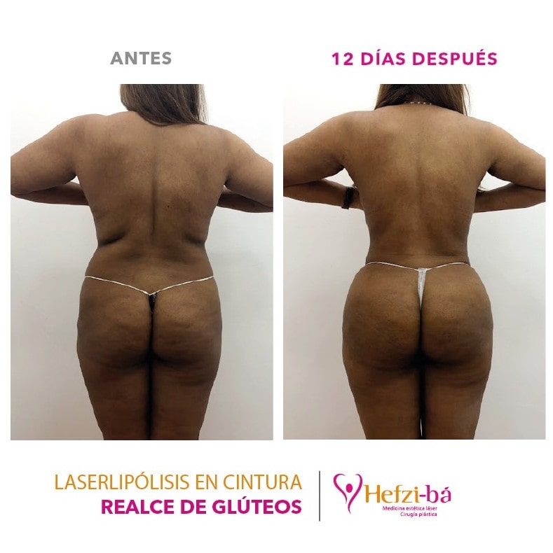 Antes y Despues Laserlipolisis 3
