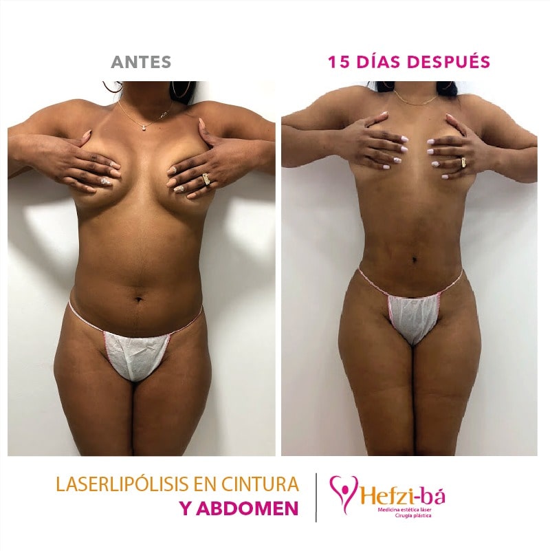Antes y Despues Laserlipolisis 4