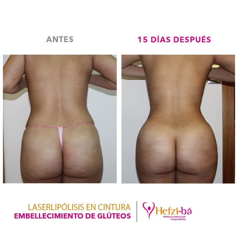 Antes y Despues Laserlipolisis 5