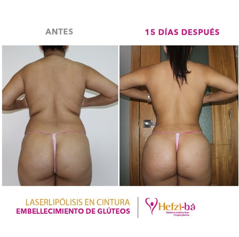 Antes y Despues Laserlipolisis 6