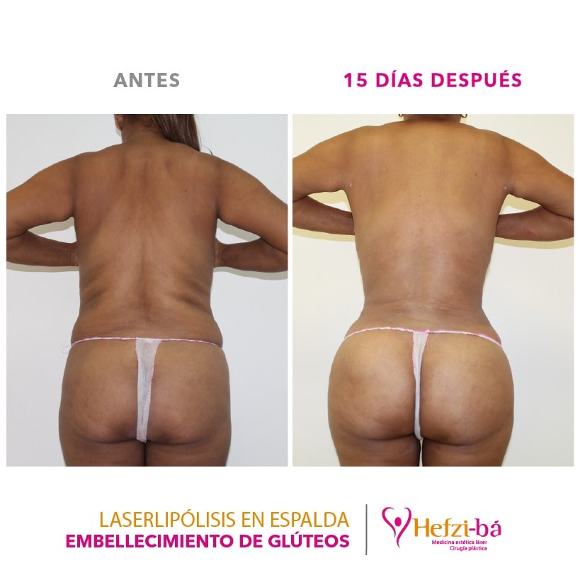 Antes y Despues Laserlipolisis 7