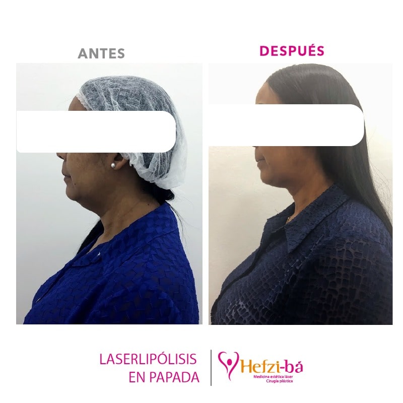Antes y Despues Laserlipolisis 8